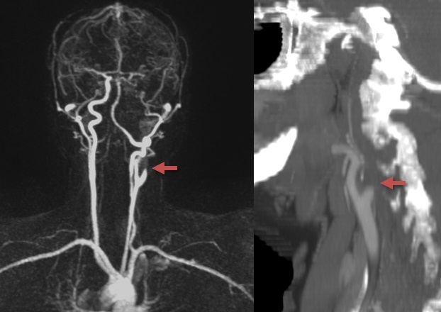 ica occlusion cta mra