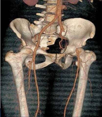 iliac arter ct angiography 2