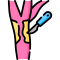 carotid endarterectomy (2)